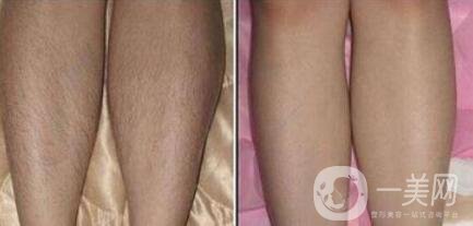 怎么去腿毛？*脫腿毛的方式是什么？