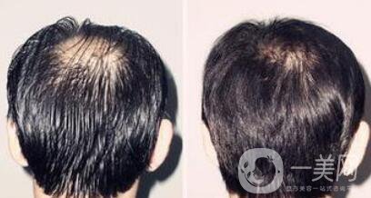 蛋白纖維植發(fā)好不好？植發(fā)解決頭發(fā)稀疏的問題