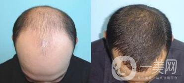 蛋白纖維植發(fā)好不好？植發(fā)解決頭發(fā)稀疏的問題