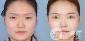 怎樣變瓜子臉？磨骨整形還是*？