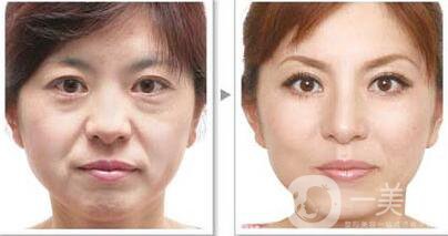 *除皺*嗎？可以維持多久的時(shí)間？