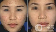 果酸換膚*嗎？果酸換膚要做幾個(gè)療程？