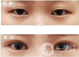 杭州,割雙眼皮,多少錢