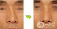 歪鼻矯正術(shù)難度大嗎？手術(shù)注意事項(xiàng)有哪些？