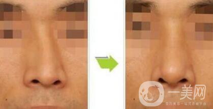 歪鼻矯正術(shù)難度大嗎？手術(shù)注意事項(xiàng)有哪些？