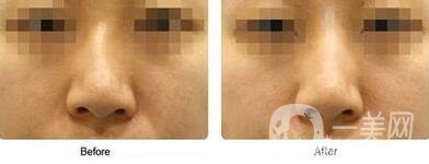 歪鼻矯正術(shù)難度大嗎？手術(shù)注意事項(xiàng)有哪些？