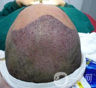 北京醫(yī)院做人工頭發(fā)種植價(jià)格 發(fā)際線后移也不是問(wèn)題 