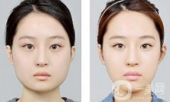 怎樣變瓜子臉？可以打*嗎？