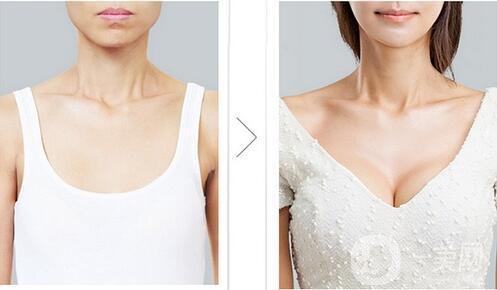 假體隆胸恢復(fù)期要多久 假體隆胸輕松擁有網(wǎng)紅傲人身材