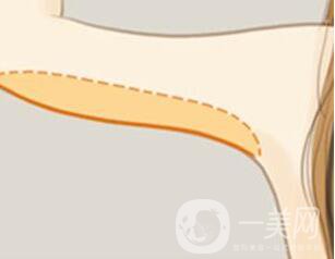 上臂吸脂減肥術(shù),多少錢