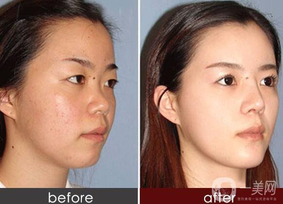 隆鼻,術(shù)后護(hù)理