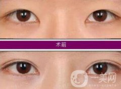 開(kāi)眼角增生了能恢復(fù)嗎?開(kāi)眼角會(huì)留疤嗎