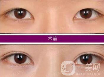 開眼角增生了能恢復(fù)嗎?開眼角會留疤嗎