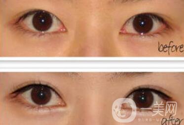 開眼角增生了能恢復(fù)嗎?開眼角會留疤嗎