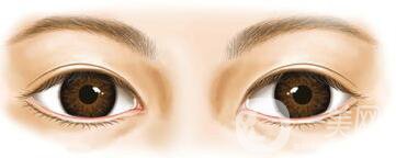 開眼角術(shù)后要眼角增生自己會消失嗎
