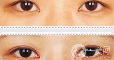 開眼角術(shù)后要眼角增生自己會消失嗎