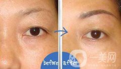 提切眉果怎么樣？提切眉手術(shù)后注意事項(xiàng)