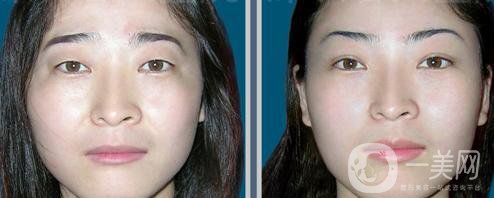 提切眉*果怎么樣？提切眉手術(shù)后注意事項(xiàng)