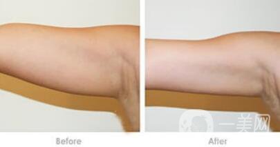 吸脂瘦手臂*果怎么樣？輕松擁有纖細(xì)手臂