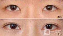 雙眼皮術(shù)后一個(gè)月能恢復(fù)自然嗎