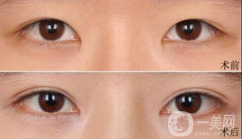 雙眼皮術(shù)后一個(gè)月能恢復(fù)自然嗎