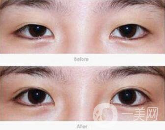 雙眼皮術(shù)后一個(gè)月能恢復(fù)自然嗎