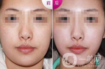 雙下巴怎么減才快速*？去雙下巴方法介紹