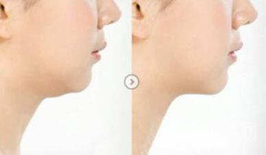 雙下巴怎么減才快速*？去雙下巴方法介紹