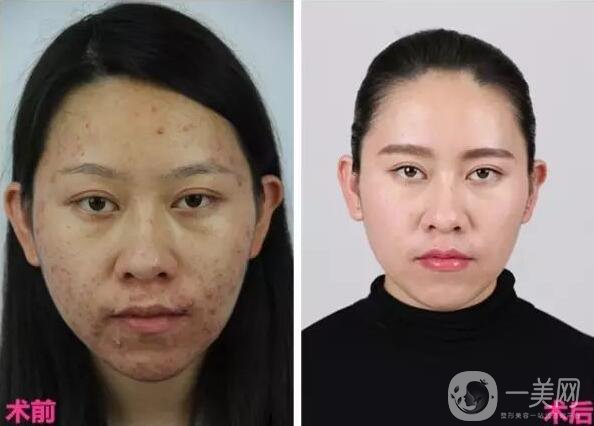 復合彩光祛痘印,價格