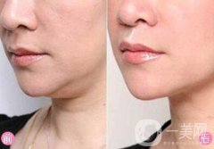 雙下巴吸脂術(shù)前準(zhǔn)備需要做哪些？