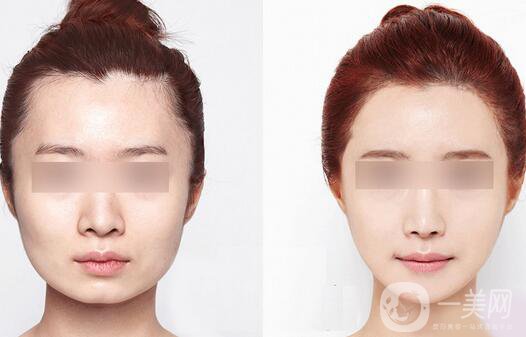 激光溶脂瘦臉注意事項(xiàng)有哪些