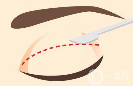 做全切雙眼皮手術(shù)之前有哪些術(shù)前準備？