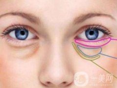 內(nèi)切祛眼袋多久恢復(fù)？