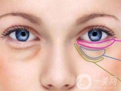 內(nèi)切祛眼袋多久恢復(fù)？