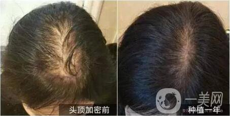 fue植發(fā)和fun植發(fā)區(qū)別有哪些 詳細介紹一覽