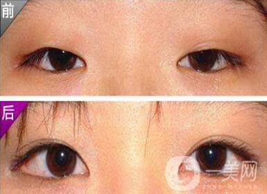 開(kāi)外眼角風(fēng)險(xiǎn)大嗎？