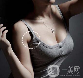 副乳切除術(shù)創(chuàng)口多大？