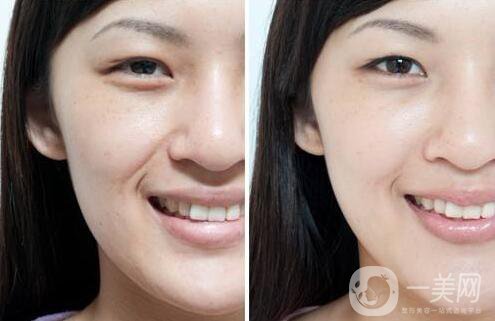 小切口面部提升,手術(shù)過程,注意事項(xiàng)