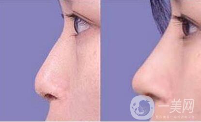 上海,鼻翼縮小.多少錢