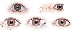 開(kāi)內(nèi)眼角要多久恢復(fù) 恢復(fù)期長(zhǎng)短和哪些因素有關(guān)