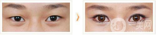 開內(nèi)眼角要多久恢復 恢復期長短和哪些因素有關(guān)