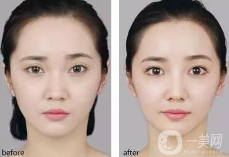 開內(nèi)眼角要多久恢復 恢復期長短和哪些因素有關(guān)