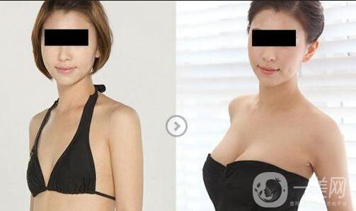 假體隆胸手術(shù)做完之后恢復(fù)期要多久時(shí)間？