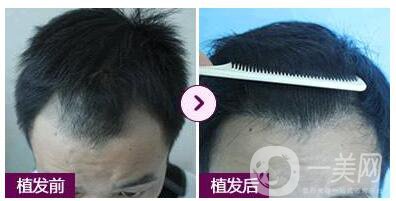 蛋白纖維植發(fā)好不好 術(shù)前術(shù)后展示