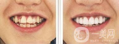 成都種植牙信息介紹？種植牙醫(yī)院信息介紹？