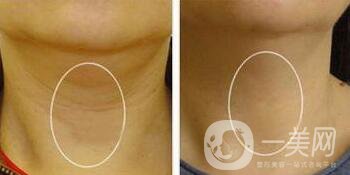 怎么消除頸紋？去頸紋的方法有哪些？