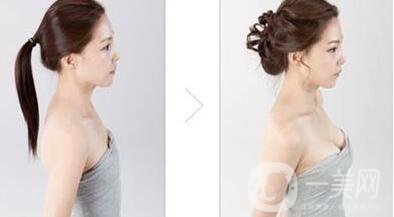 妙桃隆胸,多少錢