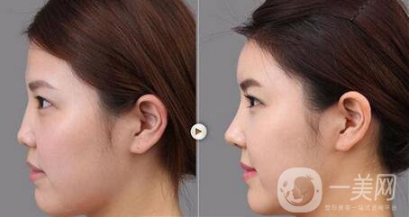 膨體隆鼻缺點主要有哪些？危害大嗎？