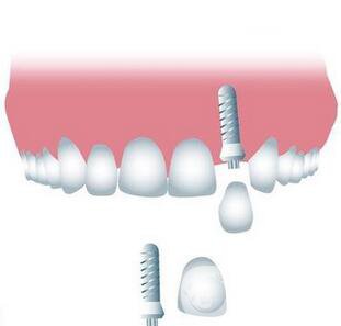 上海九院做一次種植牙價(jià)格是多少？價(jià)格貴嗎？ 