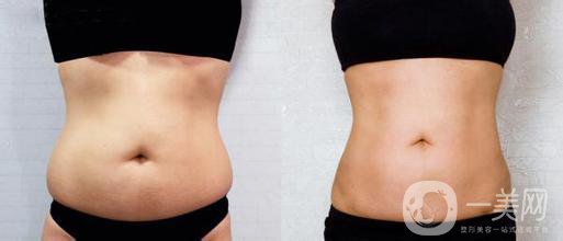 西安抽脂減肥價(jià)格 怎樣擁有好身材